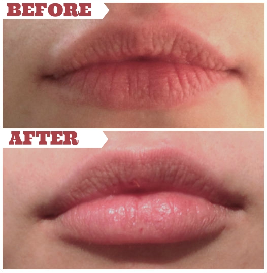An example of the smooth effect of Juvaderm