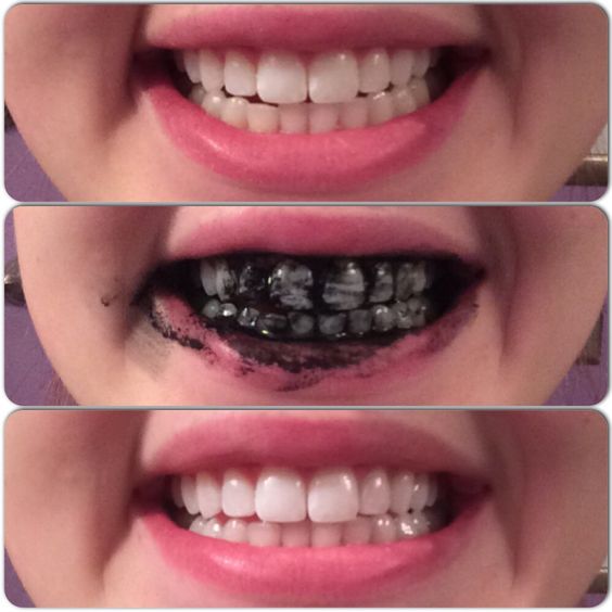 tooth-example-black-charcoal